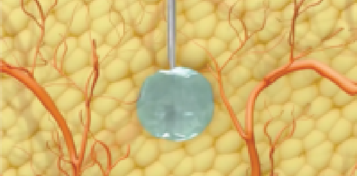Illustration showing lanreotide being injected into the deep subcutaneous layer of tissue