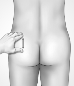 Illustration showing a hand stretching the skin on the upper left buttock