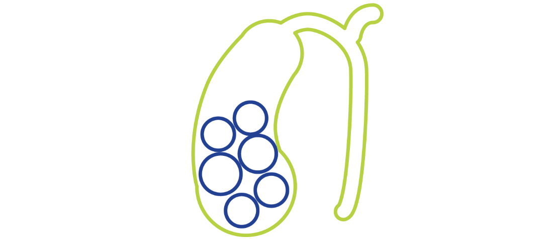 Illustration depicting gallstones.